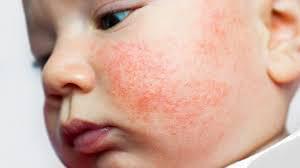 Traitement des allergies chez le bébé à perpignan